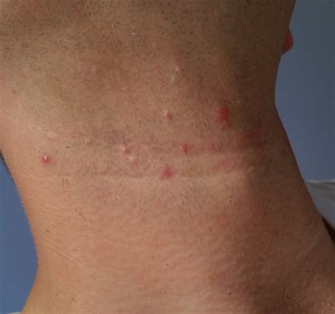 What are these bumps on my neck. : wicked_edge