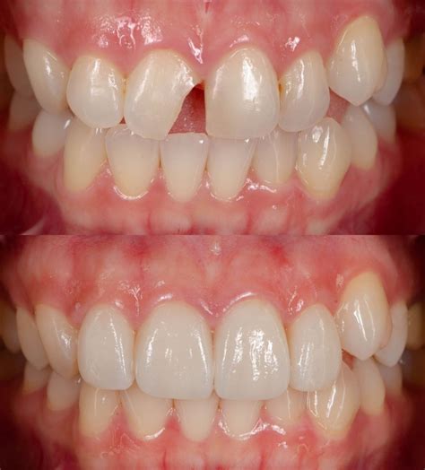 Restore Your Smile With a Dental Crown Procedure in Thailand