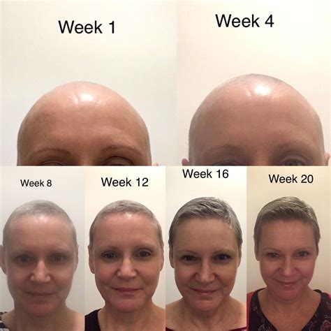 Hair growth after chemo timeline with monthly pictures – Artofit