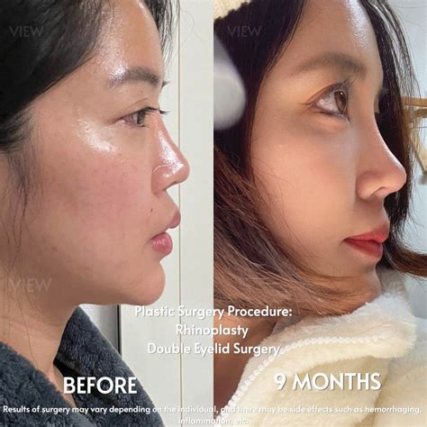 My full face makeover in dream plastic surgery clinic korea before and after surgery – Artofit