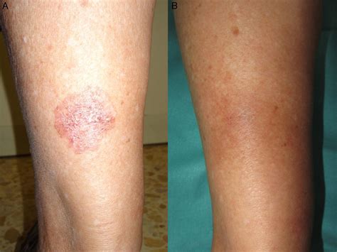 Tratamiento de la enfermedad de Bowen con terapia fotodinámica y ...