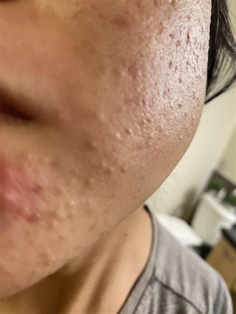 Closed comedones : r/acne
