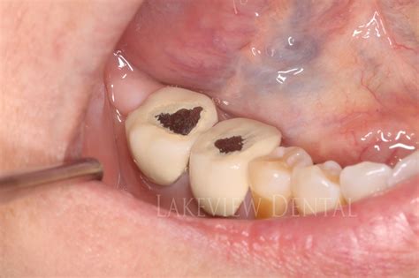 Replacing chipped crowns - Lakeview Dental