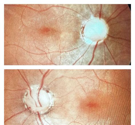 Aliaa Farag on LinkedIn: Morning glory syndrome