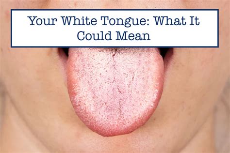 Normal White Tongue Frontiers | Relationship Between Thick Or Greasy