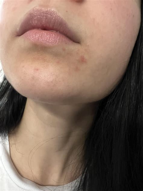 Rash vs acne around lips…help! : Skincare_Addiction