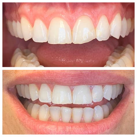 Affordable Veneers LA | Veneers Dentist West Hollywood