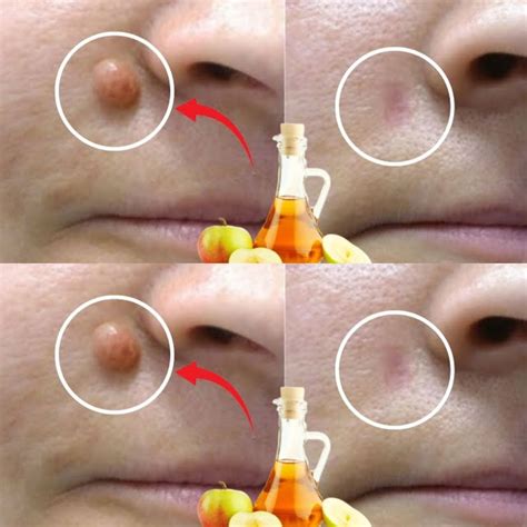 Apple cider vinegar can help get rid of warts quickly.