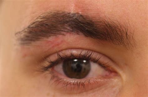 Scar on the Eyebrow Causes, Treatments, and Styling Tip