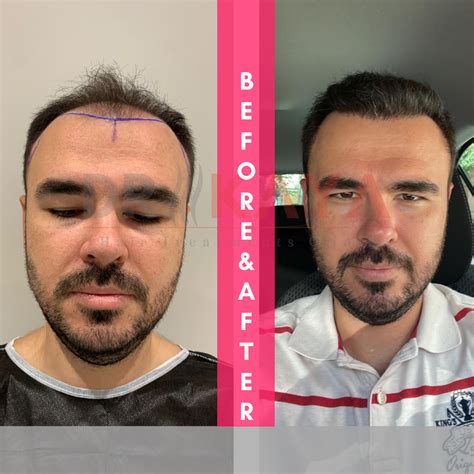 Does Hair Transplant Work? - Doctor Mahmut Alan Kaya