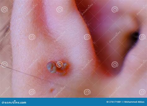 Wart On Ear
