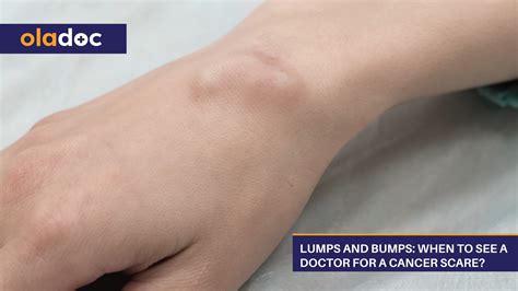 Lumps And Bumps: When To See A Doctor For A Cancer Scare? | Healthy Lifestyle | oladoc.com