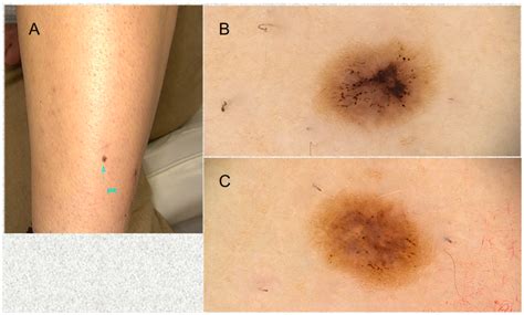 Clinical and Dermoscopic Findings of Nevi after Photoepilation: A Review