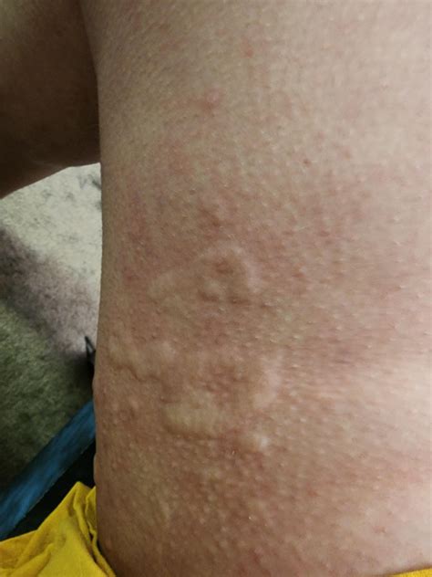 this popped up after a walk today. very itchy, raised bumps inside my thighs. any ideas? thank ...