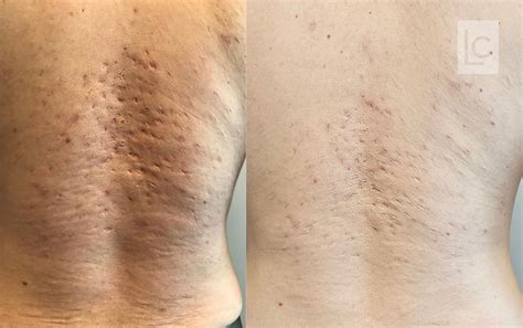 Depilacao A Laser Antes E Depois Antes E Depois Do Tratamento Com