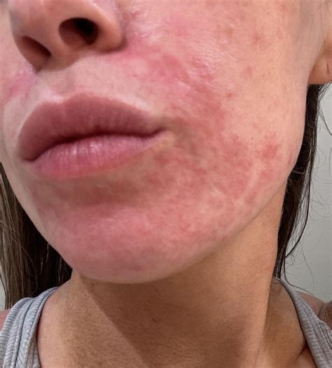 Pregnancy Rash : r/SkincareAddicts