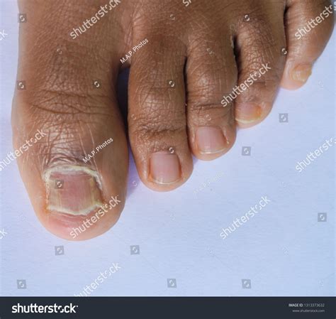 Black People Toenails