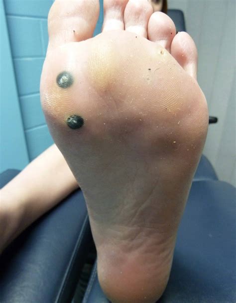 Warts Removal