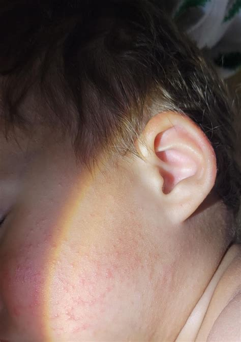 Gianotti-crosti syndrome, dermatitis, or eczema : r/Dermatology