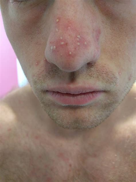 Face Acne Whitehead at Beverly Marone blog