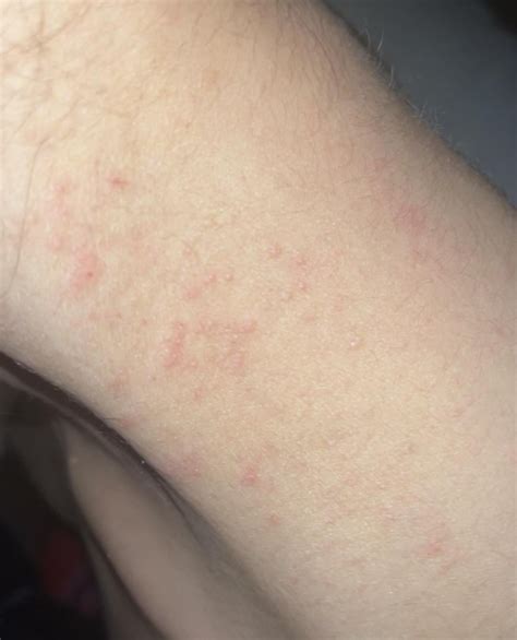 Does anyone know what this rash is? Happened after I developed a fever ...