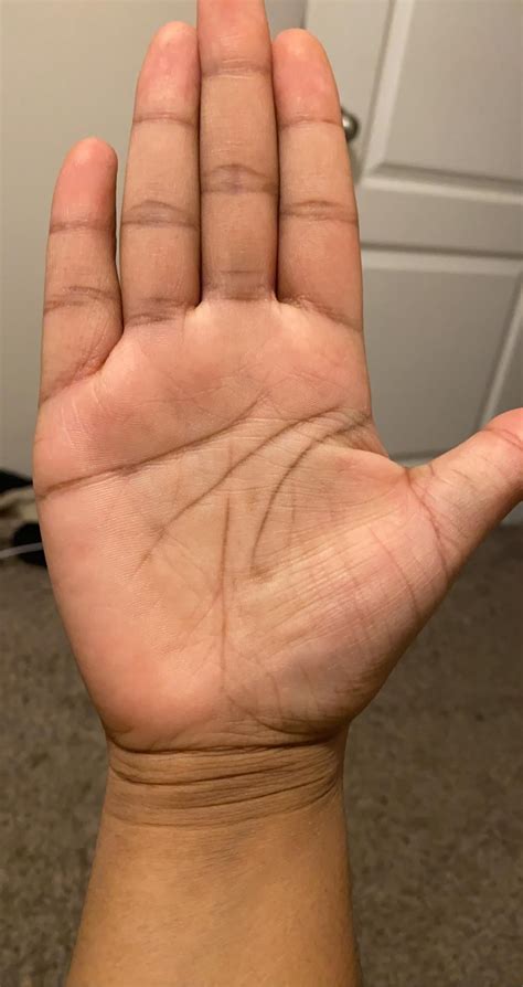 Is this normal? What are these brown marks? I overthink/over worry ALOT. These spots appeared ...