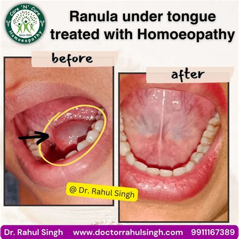 #ranula #oralranula #mucoceles #oralcysttreatment #oralcysts… | Rahul Singh