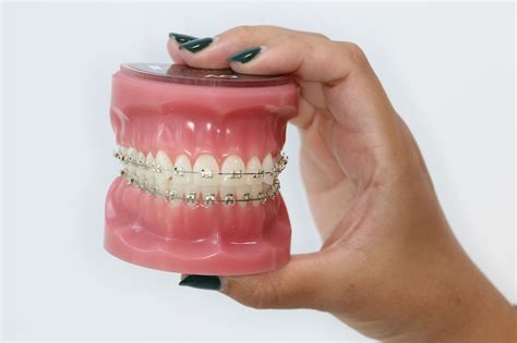 Braces - Hawthorn Orthodontics