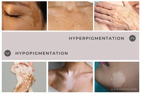How to Tell If Hyperpigmentation Is Permanent? – Kallinz