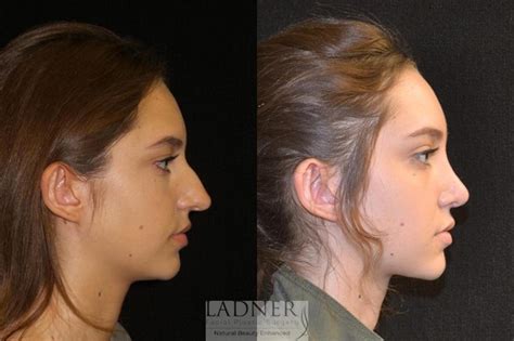 Rhinoplasty (Nose job) Before and After Pictures Case 19 | Denver, CO | Ladner Facial Plastic ...