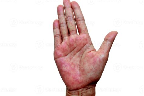 La dermatitis atópica, también conocida como eccema atópico, es un tipo ...
