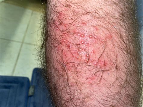Clusters of pimple like bumps all over my legs. Please help. : r/DiagnoseMe