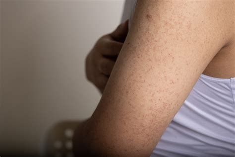 Keratosis Pilaris: The Bumps No One Talks About (But Everyone Googles) - Forefront Dermatology