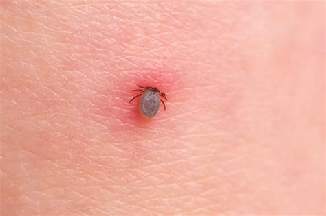 How to Treat a Tick Bite Correctly, According to Dermatologists