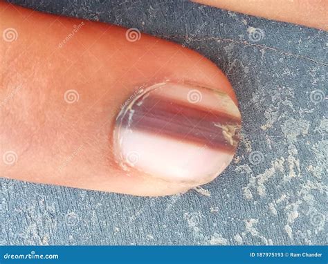 Nail Melanoma Stock Photos - Free & Royalty-Free Stock Photos from Dreamstime