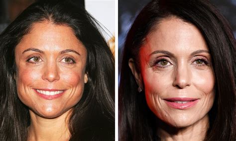 Bethenny Frankel Face Surgery
