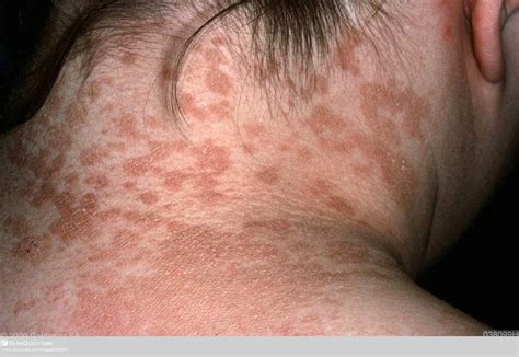 Tinea Versicolor | Current Health Advice, Health Blog Articles and Tips