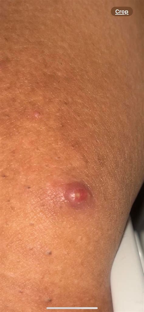 pimple popping community