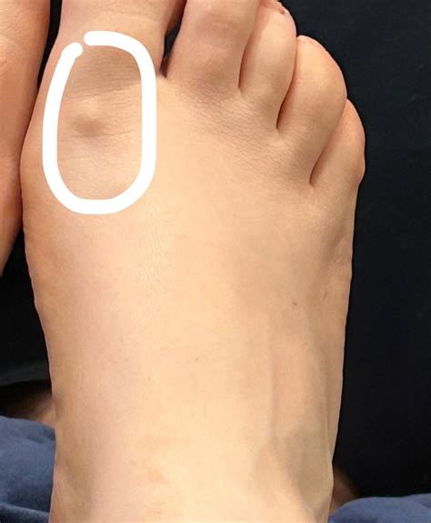 Lump On My Foot Near Big Toe Hotsell | emergencydentistry.com