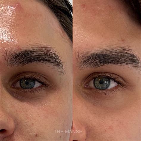 Platelet Rich Plasma: PRP injections expert Sydney Clinic