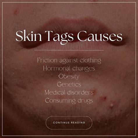 Skin Tags Causes