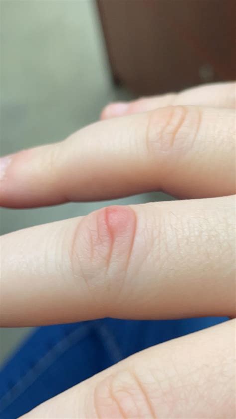 21F Bump On Finger Joint, Anyone Know What This Could Be? (More context in the comments) : r ...