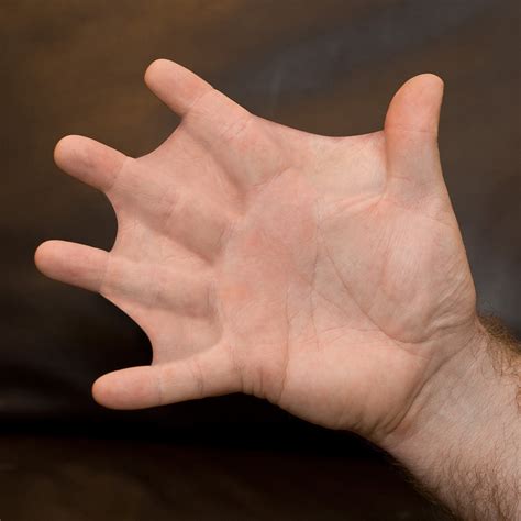 Humans With Webbed Fingers And Toes