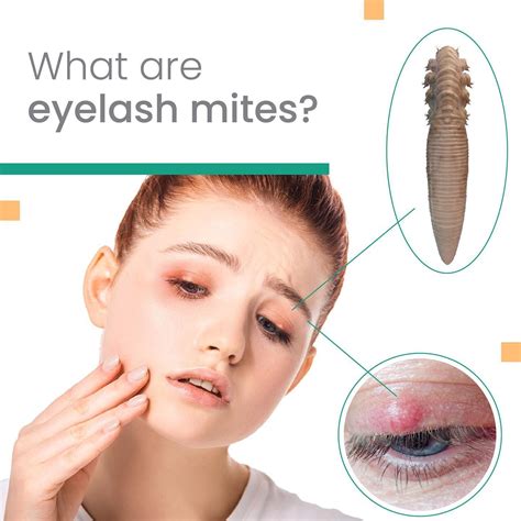 What are eyelash mites? . There are two types of Demodex mites called ...