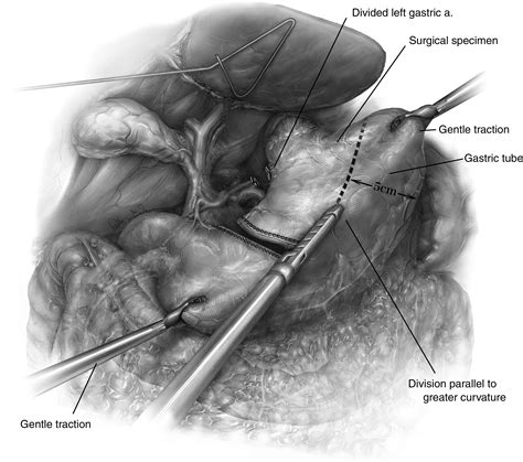 Technique of Minimally Invasive Ivor Lewis Esophagectomy - Operative Techniques in Thoracic and ...