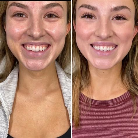Botox Lip Flip Before and After Photos Scottsdale & Phoenix, AZ