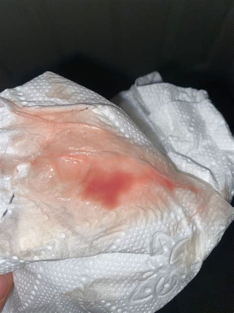 Cottage Cheese Discharge With Pink Blood at Ryder Krichauff blog