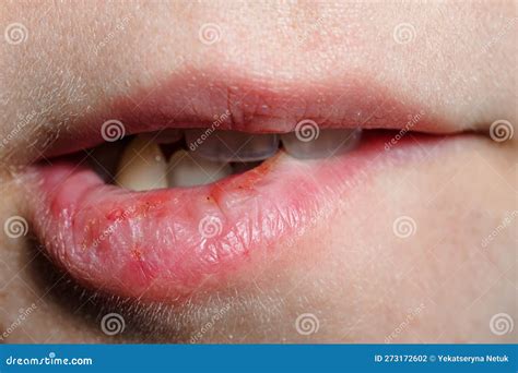 Macro Lips with Severely Dry Bleeding Cracked or Chapped Lips. Stock ...