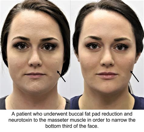 Face Fat Removal Surgery Ayer Ma