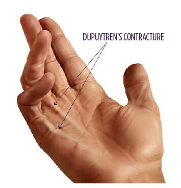 Dupuytren's Contracture | Summit Orthopedics